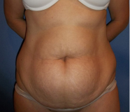 Tummy Tuck Before and After Pictures Washington, DC