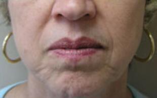 Wrinkle Removal Before and After Pictures Washington, DC
