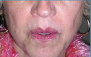 Wrinkle Removal Before and After Pictures Washington, DC