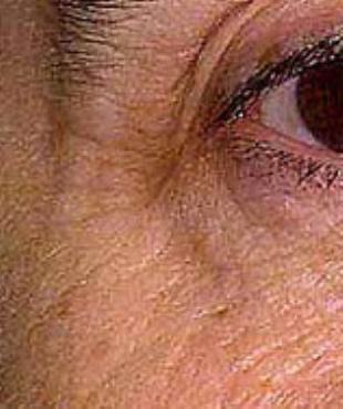 Wrinkle Removal Before and After Pictures Washington, DC