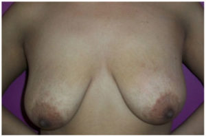 Breast Reduction Before and After Pictures Washington, DC