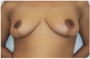 Breast Reduction Before and After Pictures Washington, DC