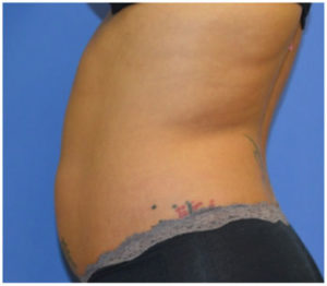 Liposuction Before and After Pictures Washington, DC