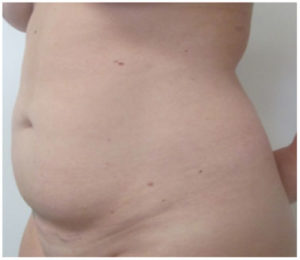 Liposuction Before and After Pictures Washington, DC