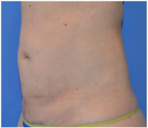 Liposuction Before and After Pictures Washington, DC