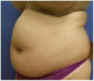 Liposuction Before and After Pictures Washington, DC