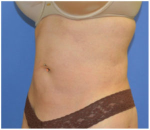 Liposuction Before and After Pictures Washington, DC