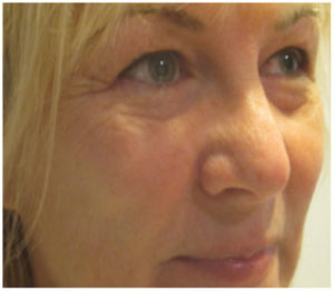 Eyelid Surgery Before and After Pictures Washington, DC