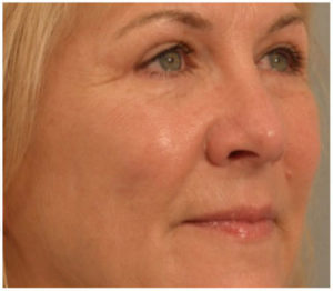 Eyelid Surgery Before and After Pictures Washington, DC