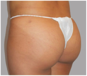 Fat Transfer to Buttocks Before and After Pictures Washington, DC