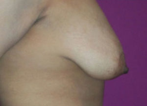 Breast Reduction Before and After Pictures Washington, DC