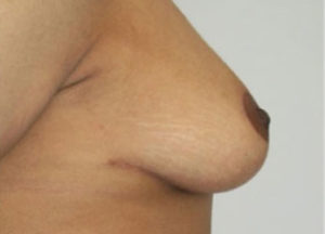 Breast Reduction Before and After Pictures Washington, DC