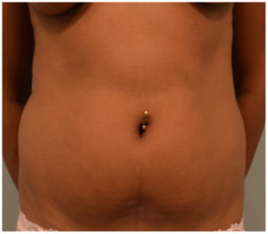 Liposuction Before and After Pictures Washington, DC