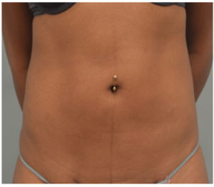 Liposuction Before and After Pictures Washington, DC