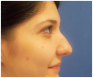 Rhinoplasty Before and After Pictures Washington, DC