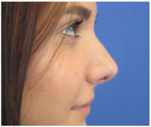 Rhinoplasty Before and After Pictures Washington, DC