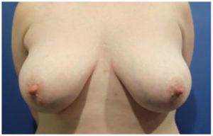 Breast Reduction Before and After Pictures Washington, DC