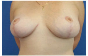 Breast Reduction Before and After Pictures Washington, DC