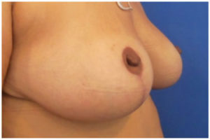Breast Reduction Before and After Pictures Washington, DC