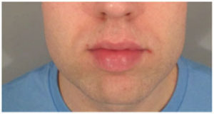 Chin Implants Before and After Pictures Washington, DC