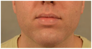 Chin Implants Before and After Pictures Washington, DC