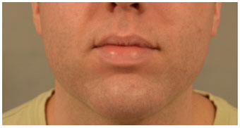 Chin Implants Before and After Pictures Washington, DC