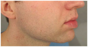 Chin Implants Before and After Pictures Washington, DC