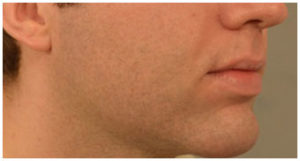 Chin Implants Before and After Pictures Washington, DC