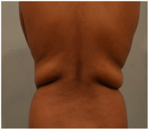 Liposuction Before and After Pictures Washington, DC