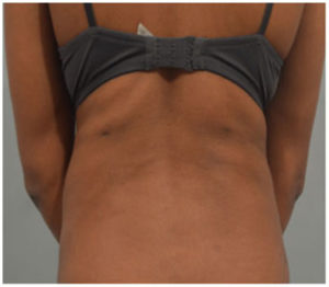 Liposuction Before and After Pictures Washington, DC