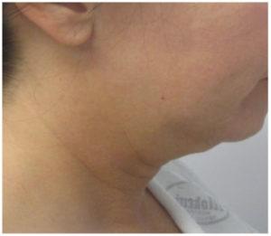 Neck Lift Before and After Pictures Washington, DC