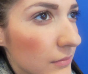 Rhinoplasty Before and After Pictures Washington, DC