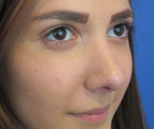 Rhinoplasty Before and After Pictures Washington, DC
