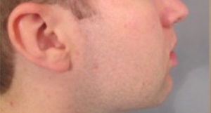 Chin Implants Before and After Pictures Washington, DC