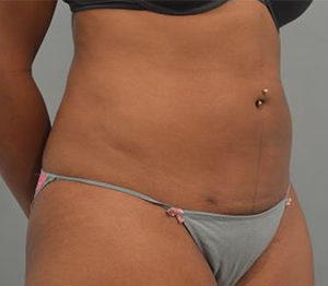 Liposuction Before and After Pictures Washington, DC