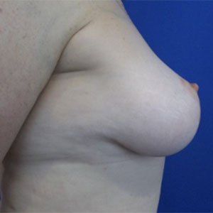 Breast Augmentation Before and After Pictures Washington, DC