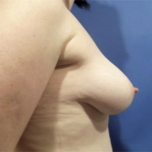 Breast Augmentation Before and After Pictures Washington, DC