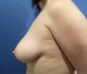 Breast Lift Before and After Pictures Washington, DC