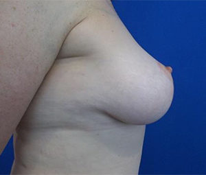 Breast Lift Before and After Pictures Washington, DC