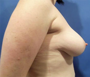 Breast Lift Before and After Pictures Washington, DC