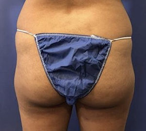 Fat Transfer to Buttocks Before and After Pictures Washington, DC