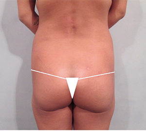 Fat Transfer to Buttocks Before and After Pictures Washington, DC