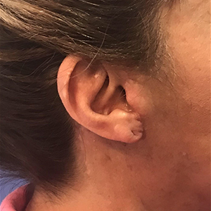 Earlobe Repair Before and After Pictures Washington, DC