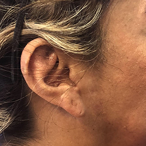 Earlobe Repair Before and After Pictures Washington, DC