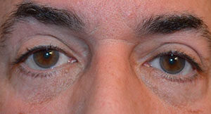 Eyelid Surgery Before and After Pictures Washington, DC