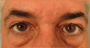 Eyelid Surgery Before and After Pictures Washington, DC