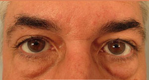Eyelid Surgery Before and After Pictures Washington, DC