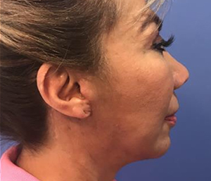 Facelift Before and After Pictures Washington, DC