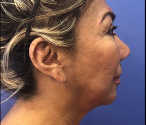 Facelift Before and After Pictures Washington, DC