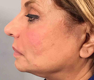 Facelift Before and After Pictures Washington, DC